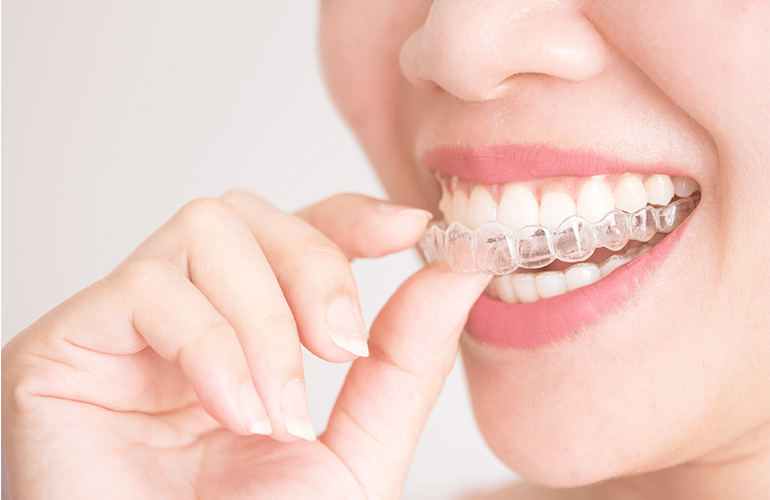 Clear Aligners
