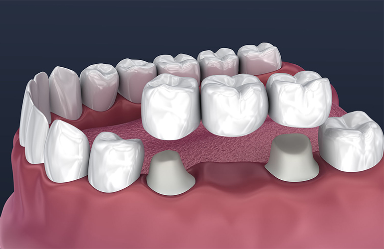 Dental Bridges