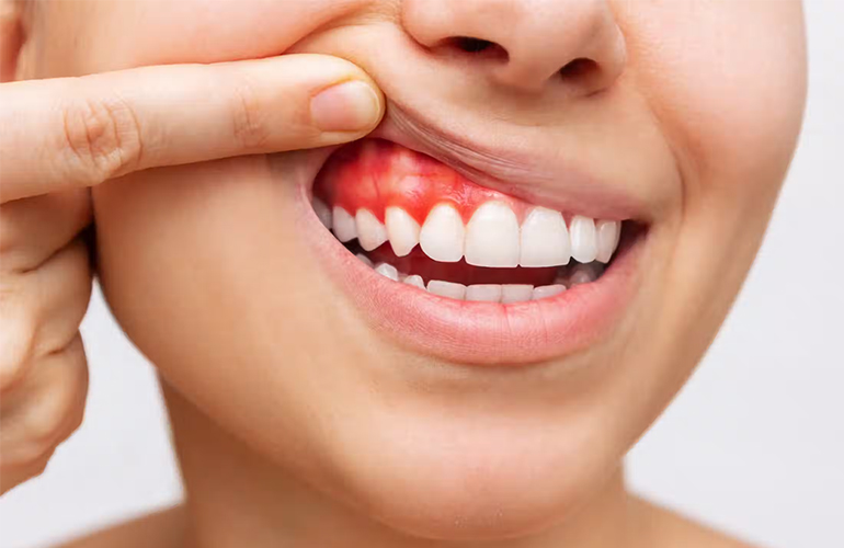 Gingivitis