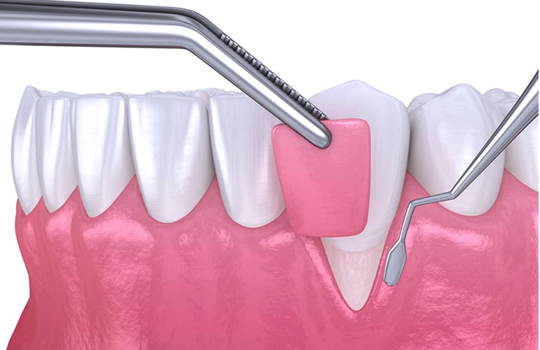 Gum Surgeries