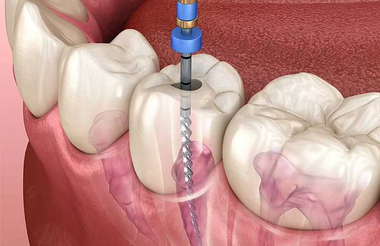 Root Canal