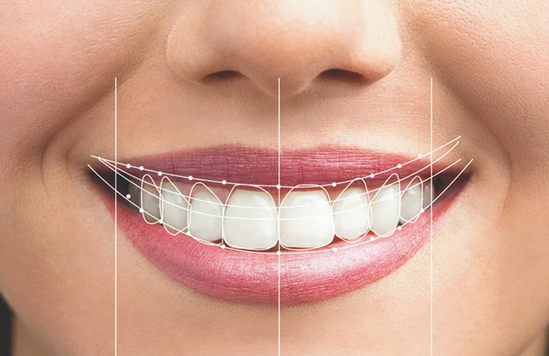 Smile Designing