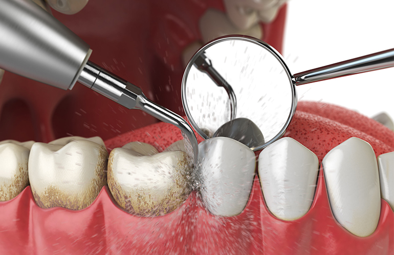 Teeth-Cleaning