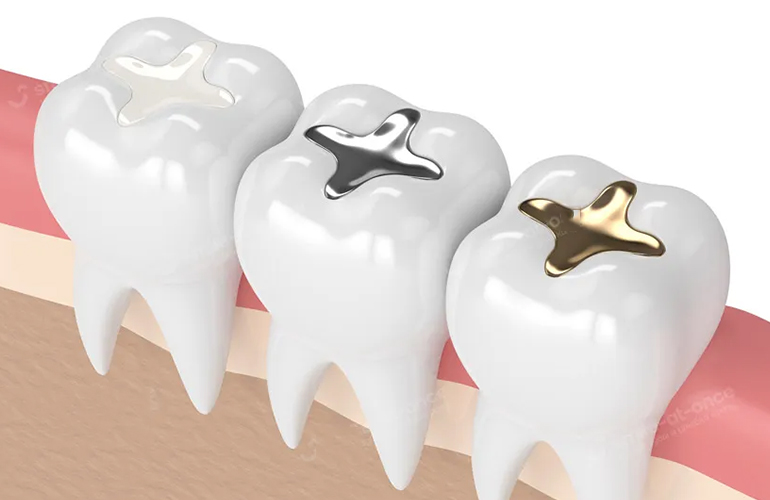 Teeth Fillings