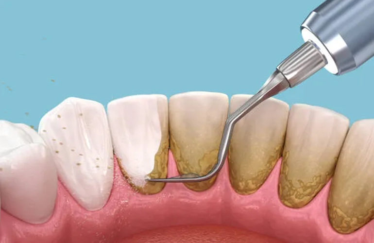 Teeth Scaling
