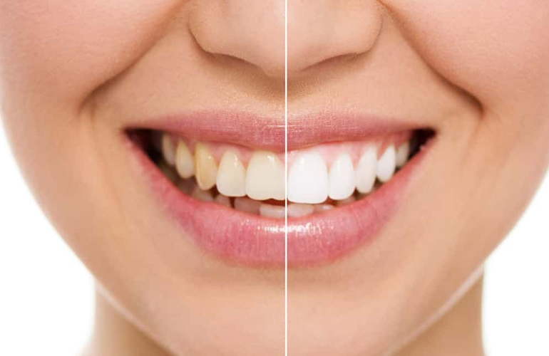 Teeth Whitening
