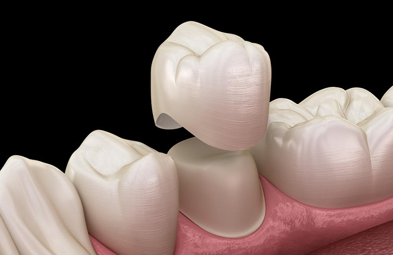 Tooth Crown