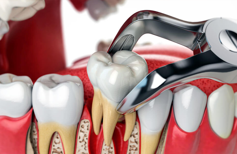 Tooth Extraction
