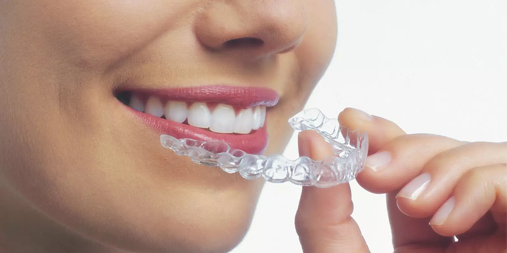 Clear Aligners