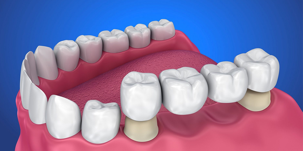 Dental Bridges