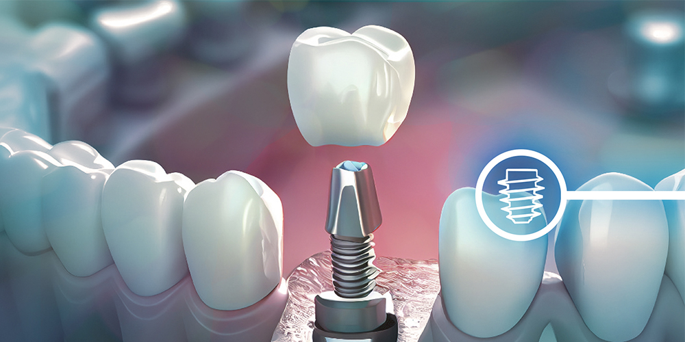 Dental Implants
