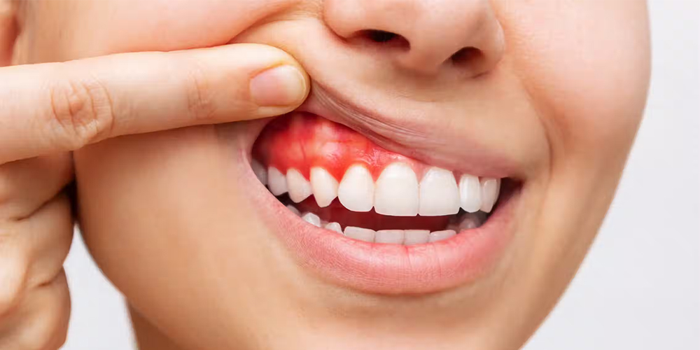 Gingivitis