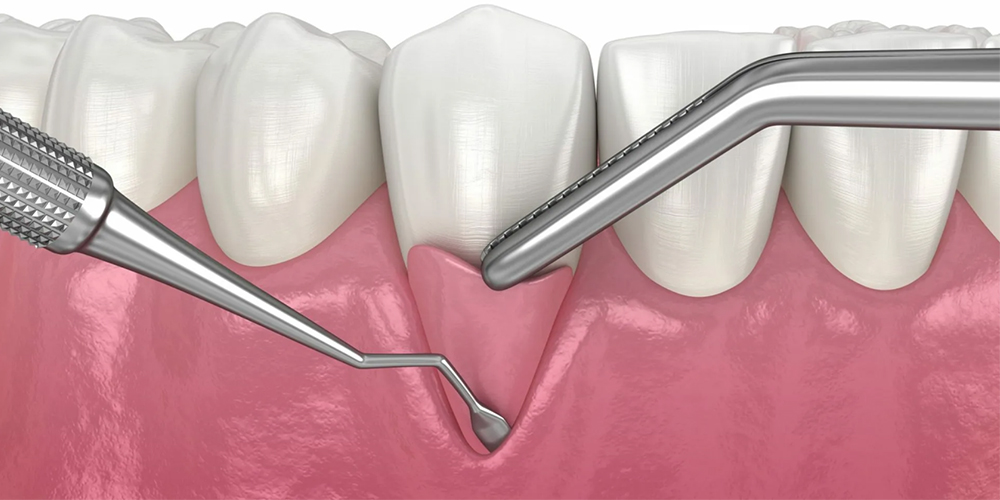 Gum Surgeries