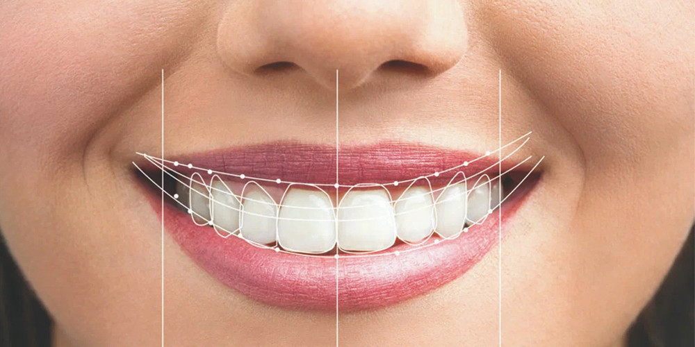Smile Designing