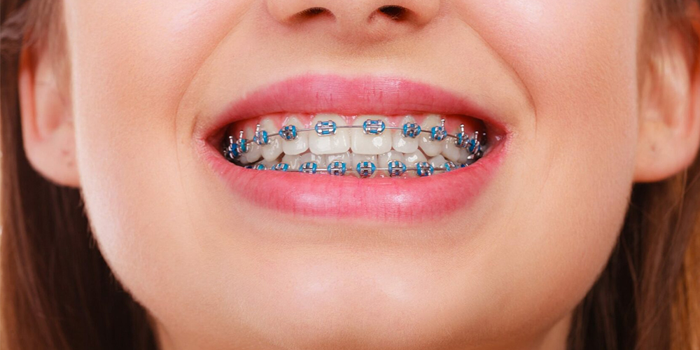 Teeth Braces