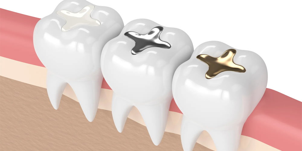 Teeth Fillings
