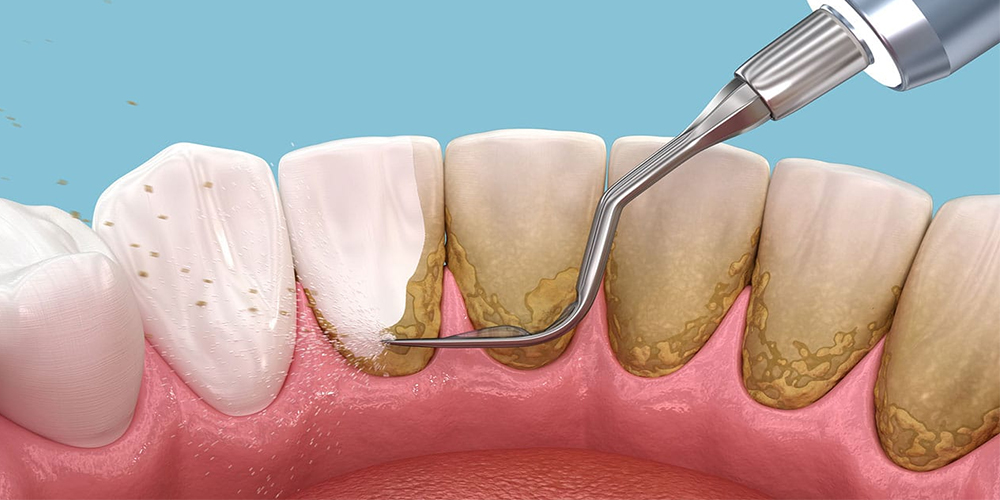 Teeth Scaling