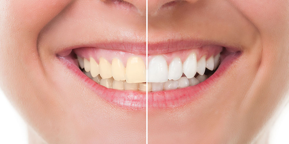 Teeth Whitening