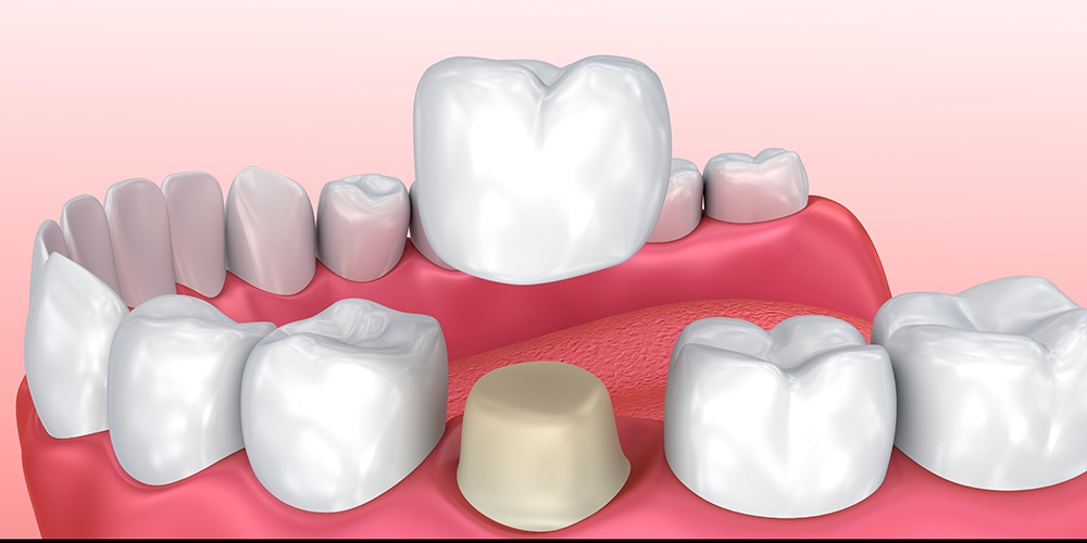 Tooth Crown