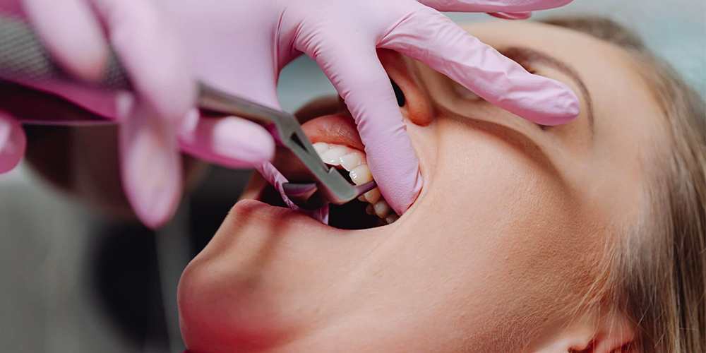 Tooth Extraction